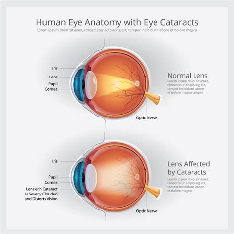 What Causes Early Onset Cataracts